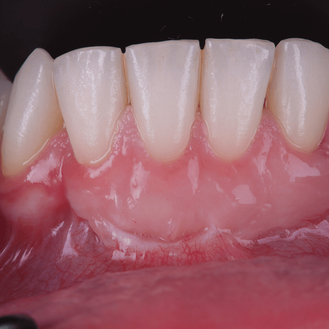 Piscitello_greffe_gingivale_libre-2