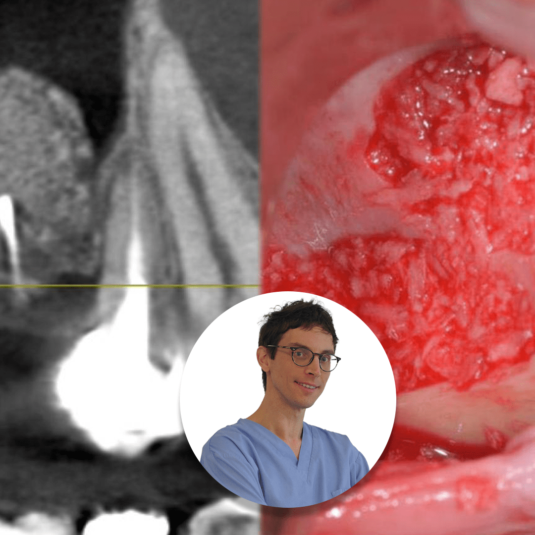 Chirurgie orale et préimplantaire : sinus lift