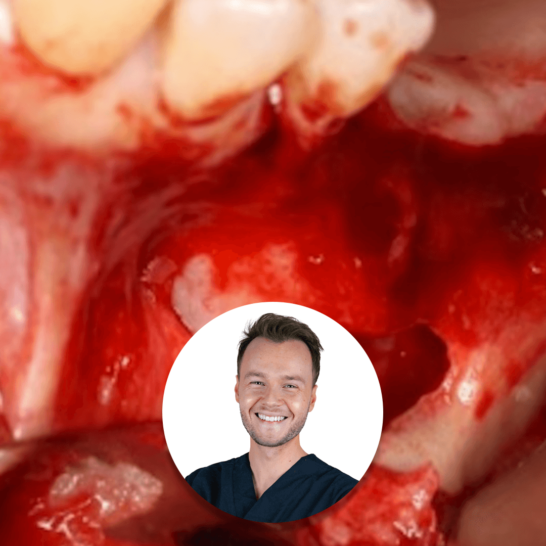 Le sinus maxillaire en implantologie