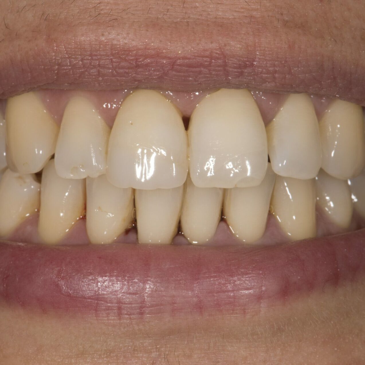 preop1