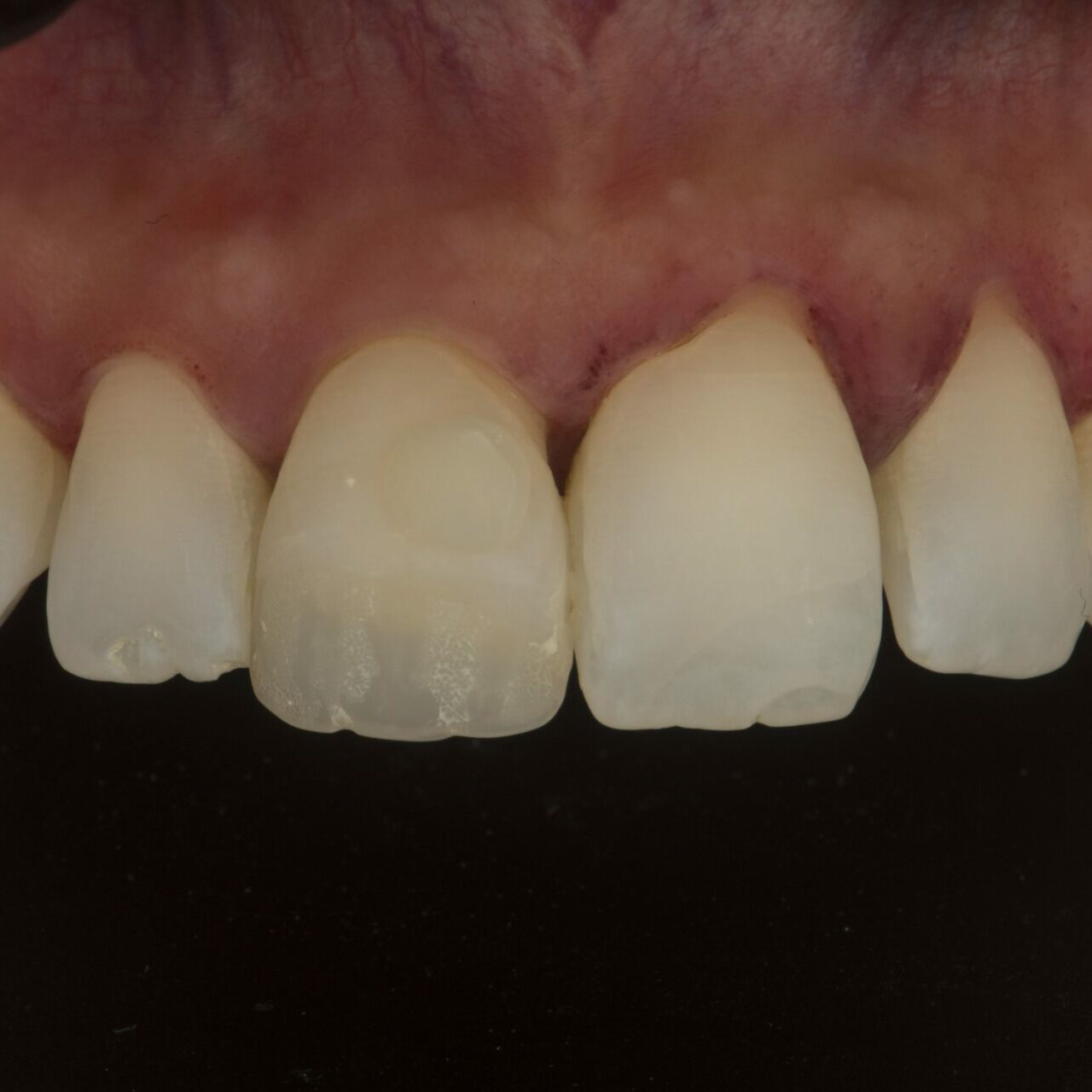 preop3
