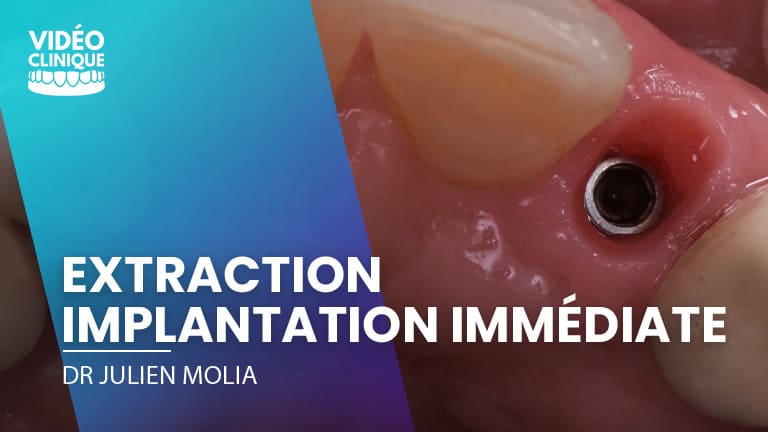 Extraction implantation et provisoire immédiates