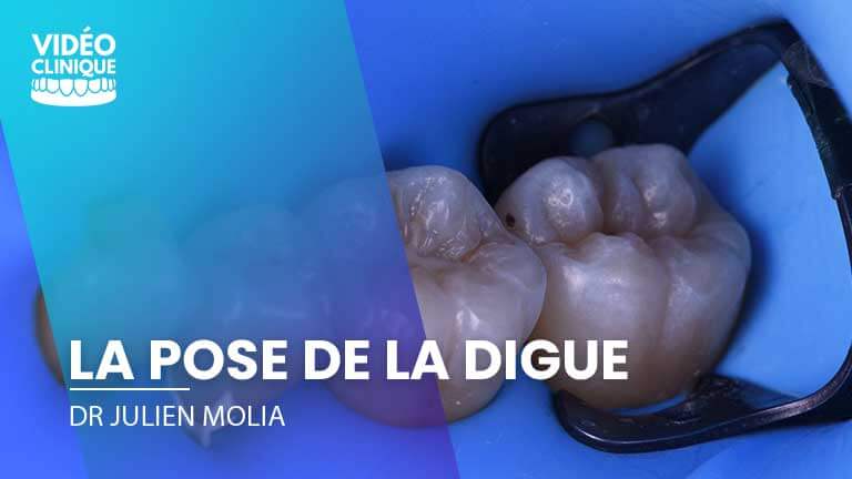 3 techniques de placement de la digue - French Tooth