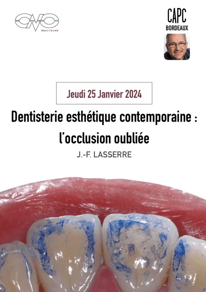 Facette dentaire à la Clinique Esthétique Aquitaine à Bordeaux