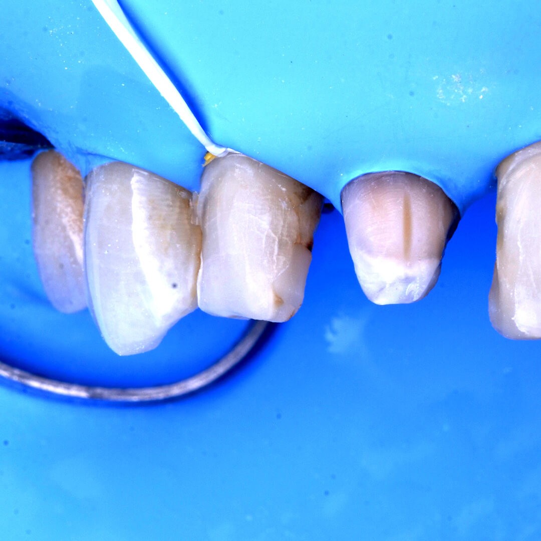Toledano_Charles_Omnipratique_Dentisterie_Esthetique_Adhesive_1_2j