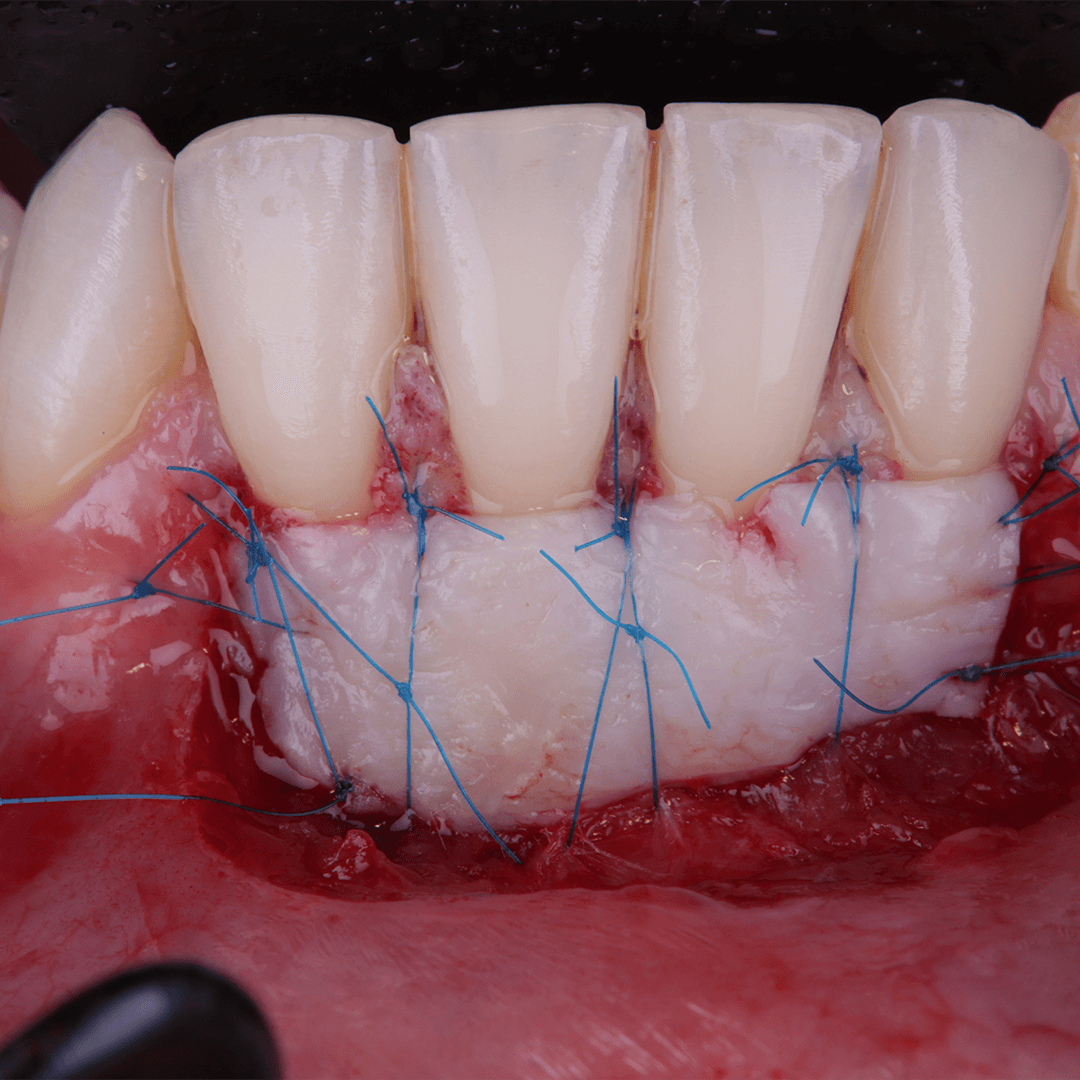 Piscitello_greffe_gingivale_libre